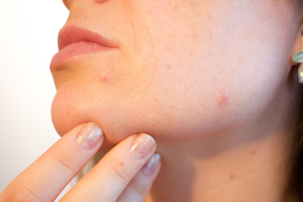 Les traitements de l’acné